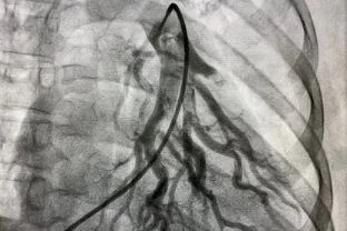 >Peripheral Angioplasty
